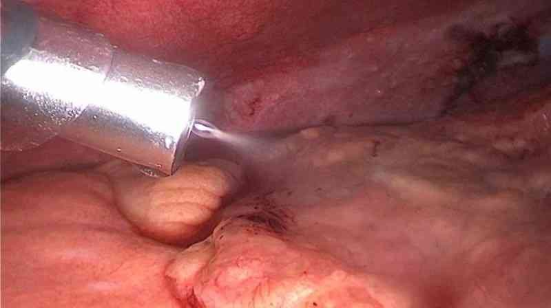 PIPAC therapy procedure, peritoneal carcinomatosis treatment, pressurized intraperitoneal chemotherapy, advanced cancer therapy, ovarian cancer PIPAC, stomach cancer intraperitoneal chemotherapy, colon cancer PIPAC therapy, appendix cancer treatment, minimally invasive PIPAC procedure, PIPAC clinical practice, National Medical Research Center Radiology, peritoneal metastases therapy, PIPAC aerosol chemotherapy, intrapleural chemotherapy PIPAC, PIPAC induction therapy, intraoperative PIPAC method, advanced oncology care, personalized cancer treatment, PIPAC patient preparation, peritoneal cancer therapy room, PIPAC procedure equipment, intraperitoneal drug delivery system, PIPAC tumor reduction therapy, PIPAC minimally invasive oncology, advanced peritoneal metastases care, PIPAC chemotherapy device, oncology treatment innovation, PIPAC clinical outcomes, intraperitoneal cancer therapy session, PIPAC patient monitoring, peritoneal carcinomatosis surgical support, aerosol chemotherapy technology, PIPAC oncology workflow, cancer treatment precision tools, advanced intraperitoneal oncology equipment, PIPAC therapy hospital setting, minimally invasive cancer therapy technology, peritoneal metastases management, PIPAC oncology medical team, intraperitoneal chemotherapy administration, advanced PIPAC therapy room, precision aerosol chemotherapy, PIPAC treatment patient safety, peritoneal cancer drug delivery, PIPAC clinical trial results, innovative cancer treatment methods, oncology procedural innovation, PIPAC therapy advantages, minimally invasive oncology procedures, peritoneal carcinomatosis care center, PIPAC treatment workflow, aerosol chemotherapy delivery system, peritoneal tumor management, PIPAC oncology technology, advanced cancer treatment center, intraperitoneal therapy clinical room, PIPAC cancer therapy innovation, peritoneal metastases clinical care, PIPAC therapeutic technique, oncology patient treatment plan, intraperitoneal chemotherapy guidance, minimally invasive oncology clinic, peritoneal tumor therapy system, PIPAC treatment effectiveness, oncology cancer care technology, PIPAC procedure hospital setup, aerosol chemotherapy patient preparation, advanced PIPAC treatment equipment, peritoneal metastases therapy session,